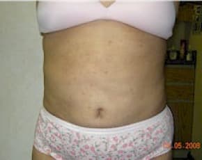 Tummy Tuck Before & After Patient #1082