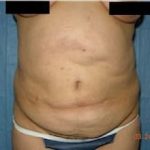Tummy Tuck Before & After Patient #1082
