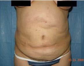 Tummy Tuck Before & After Patient #1082