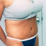 Tummy Tuck Before & After Patient #1081