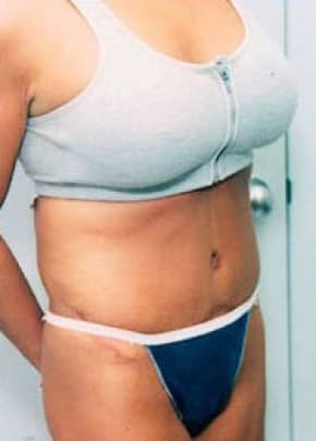 Tummy Tuck Before & After Patient #1081