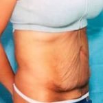 Tummy Tuck Before & After Patient #1081