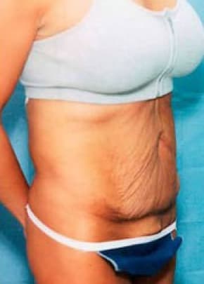 Tummy Tuck Before & After Patient #1081