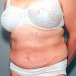 Tummy Tuck Before & After Patient #1036