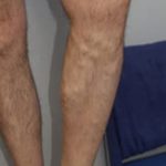 Spider Vein Removal Before & After Patient #3139