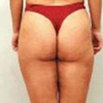 Mesotherapy Before & After Patient #3136