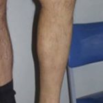 Spider Vein Removal Before & After Patient #3139