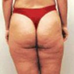 Mesotherapy Before & After Patient #3136