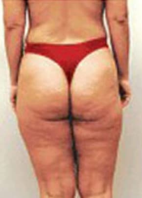 Mesotherapy Before & After Patient #3136