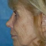 Mini Facelift Before & After Patient #3447