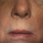 Lip Lift Before & After Patient #3657