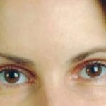 Botox Before & After Patient #2068