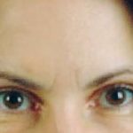 Botox Before & After Patient #2068