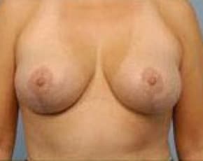 Breast Lift and Reduction Before & After Patient #2503