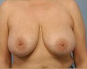 Breast Lift and Reduction Before & After Patient #2503