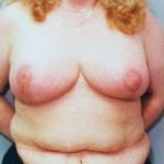 Breast Lift and Reduction Before & After Patient #2502