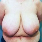 Breast Lift and Reduction Before & After Patient #2502
