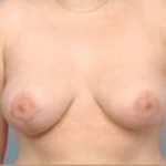 Breast Lift and Reduction Before & After Patient #2498
