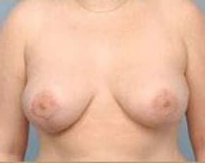Breast Lift and Reduction Before & After Patient #2498