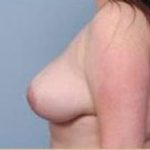Breast Lift and Reduction Before & After Patient #2498