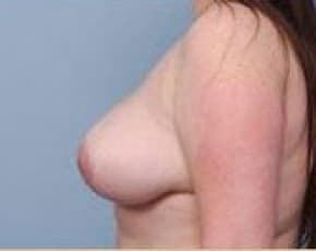 Breast Lift and Reduction Before & After Patient #2498