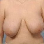 Breast Lift and Reduction Before & After Patient #2498