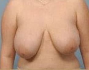 Breast Lift and Reduction Before & After Patient #2498