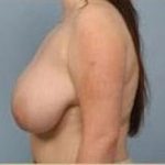 Breast Lift and Reduction Before & After Patient #2498