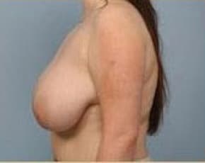 Breast Lift and Reduction Before & After Patient #2498