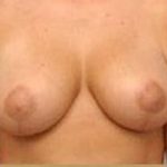 Breast Lift and Reduction Before & After Patient #2497