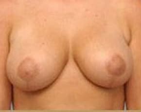 Breast Lift and Reduction Before & After Patient #2497