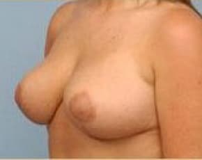 Breast Lift and Reduction Before & After Patient #2497