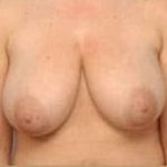 Breast Lift and Reduction Before & After Patient #2497