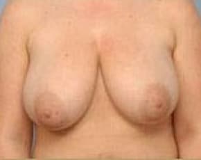 Breast Lift and Reduction Before & After Patient #2497