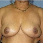Breast Lift and Reduction Before & After Patient #2496