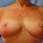 Breast Lift and Reduction Before & After Patient #2494