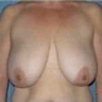 Breast Lift and Reduction Before & After Patient #2494