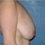 Breast Lift and Reduction Before & After Patient #2494