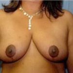 Breast Lift and Reduction Before & After Patient #2493