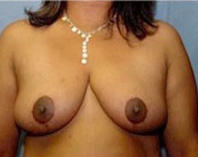 Breast Lift and Reduction Before & After Patient #2493