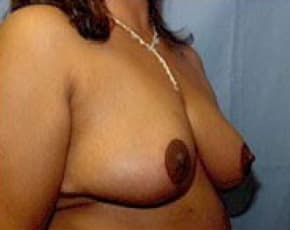 Breast Lift and Reduction Before & After Patient #2493