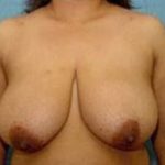 Breast Lift and Reduction Before & After Patient #2493