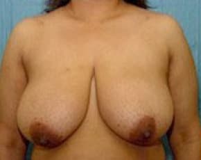 Breast Lift and Reduction Before & After Patient #2493