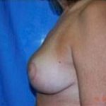 Breast Lift and Reduction Before & After Patient #2492