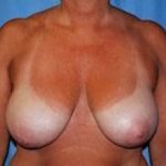 Breast Lift and Reduction Before & After Patient #2492