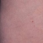 Cellfina Before & After Patient #2216