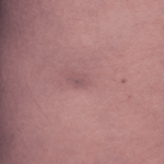 Cellfina Before & After Patient #2216