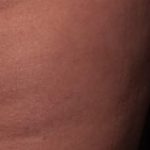 Cellfina Before & After Patient #2215