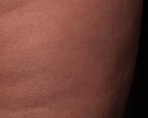 Cellfina Before & After Patient #2215