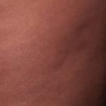 Cellfina Before & After Patient #2215